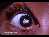 pigmented persistent pupillary membrane with congenital cataract