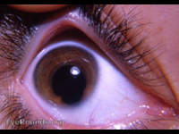 congenital coloboma of the iris, right eye
