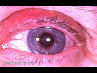 congenital ectropion uveae