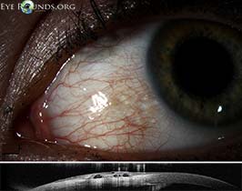 Conjunctival lymphangiectasis