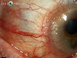 Conjunctival invasive squamous cell carcinoma