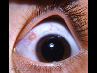 bulbar conjunctival cyst