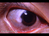 corneoconjunctival (limbal) dermoid tumor