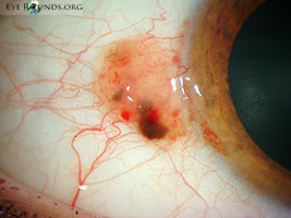 Conjunctival melanoma