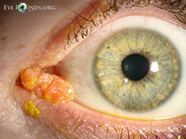 Conjunctival melanoma