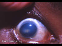 familial corneal dystrophy
