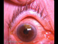 stained marginal corneal abrasion between superior limbus and light reflex.