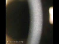 Fuch's Endothelial Corneal Dystrophy