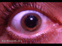 corneal contact lens