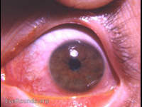 corneal abrasion with reflex spastic miosis