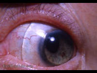 corneoscleral contact lens