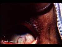 Telltale scleral scar in a couched eye, couching