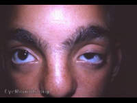 craniofacial dysostosis