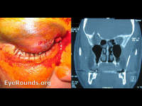 lid laceration and superior orbital roof fracture