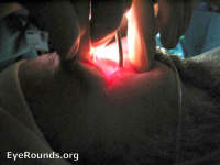 cryotherapy with indirect ophthalmoscopy