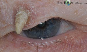 Cutaneous Horn