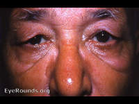 cutis laxa/dermatochalasis palpebrae