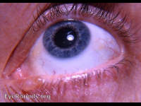 lid margin cyst of ciliary gland of Moll