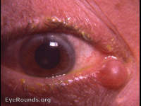 cyst of a gland of Mol