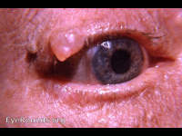 papilloma upper lid with cyst of gland of Moll