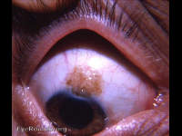 cystic pigmented nevus of the bulbar conjunctiva