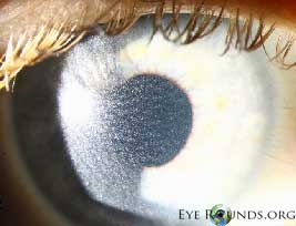 Cystinosis