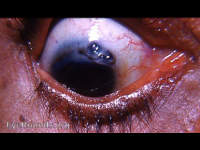 cytoid cicatrix of the limbus