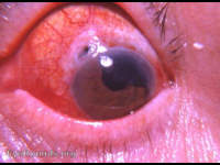 Cystoid cicatrix and ectropion uveae following intracapsular cataract surgery with a complete iridectomy