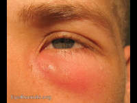 dacryocystitis