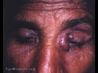 chronic dacryocysitis with abscess formation