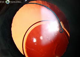 Decentered posterior chamber intraocular lens