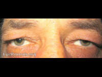 dermatochalasis