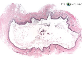 dermoid cyst