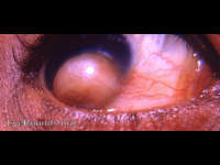 dermoid tumor of cornea