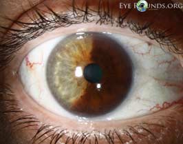 Diffuse iris nevus