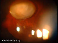 dislocated cataractous lens
