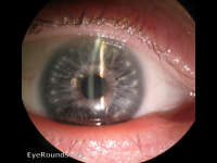 Down's Syndrome with brushfield's spots on the iris