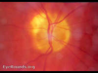 optic nerve drusen