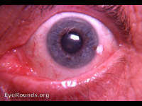 Limbal dyskeratosis