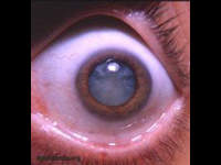 dystrophia myotonica with cataracta complicata