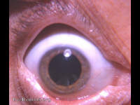 cortical cataractous changes
