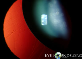 Ectopia Lentis in Marfan's syndrome