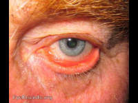ectropion