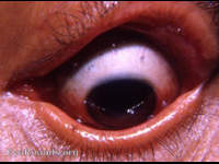 Ectropion, right upper lid, from burn