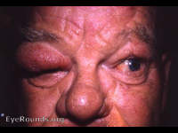 elephantiasis nostras