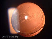Aftercataract (Elschnig's pearls)