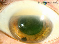 Emulsified silicon oil in Anterior Chamber