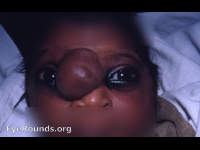congenital encephalocele / meningocele