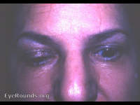 lid retraction due to thyroid dysfunction