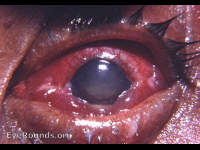 Acute endophthalmitis during immediate post- cataract surgery